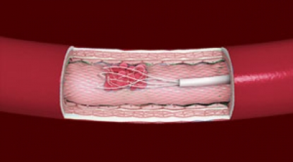 Тромбэктомия при инсульте вследствие дистальной окклюзии задней мозговой артерии: исследование TOPMOST