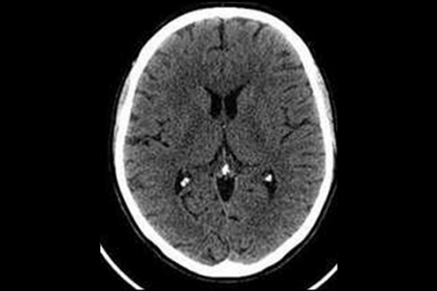 Рисунок 2а. КТ головного мозга больного ишемическим инсультом спустя 3 часа от дебюта инсульта (отсутствуют изменения в мозговой ткани)