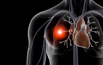 Профилактика кардиоэмболического инсульта у пациентов, переносящих венозные тромбоэмболические события